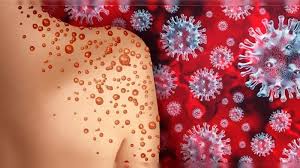 “Monkeypox Alert” – Pakistan Confirms Fourth Case as KP Reports Another Infection