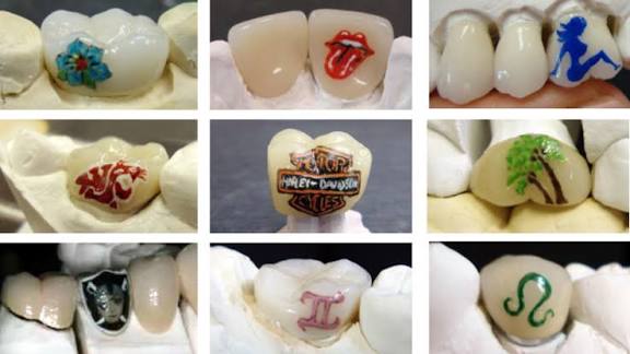 Tooth Tattoos Viral Trend in China Opens — Beauty Trend or Dental Disaster?